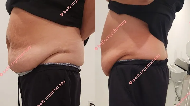 Bel0 Cryotherapy LLC in East Hanover, NJ